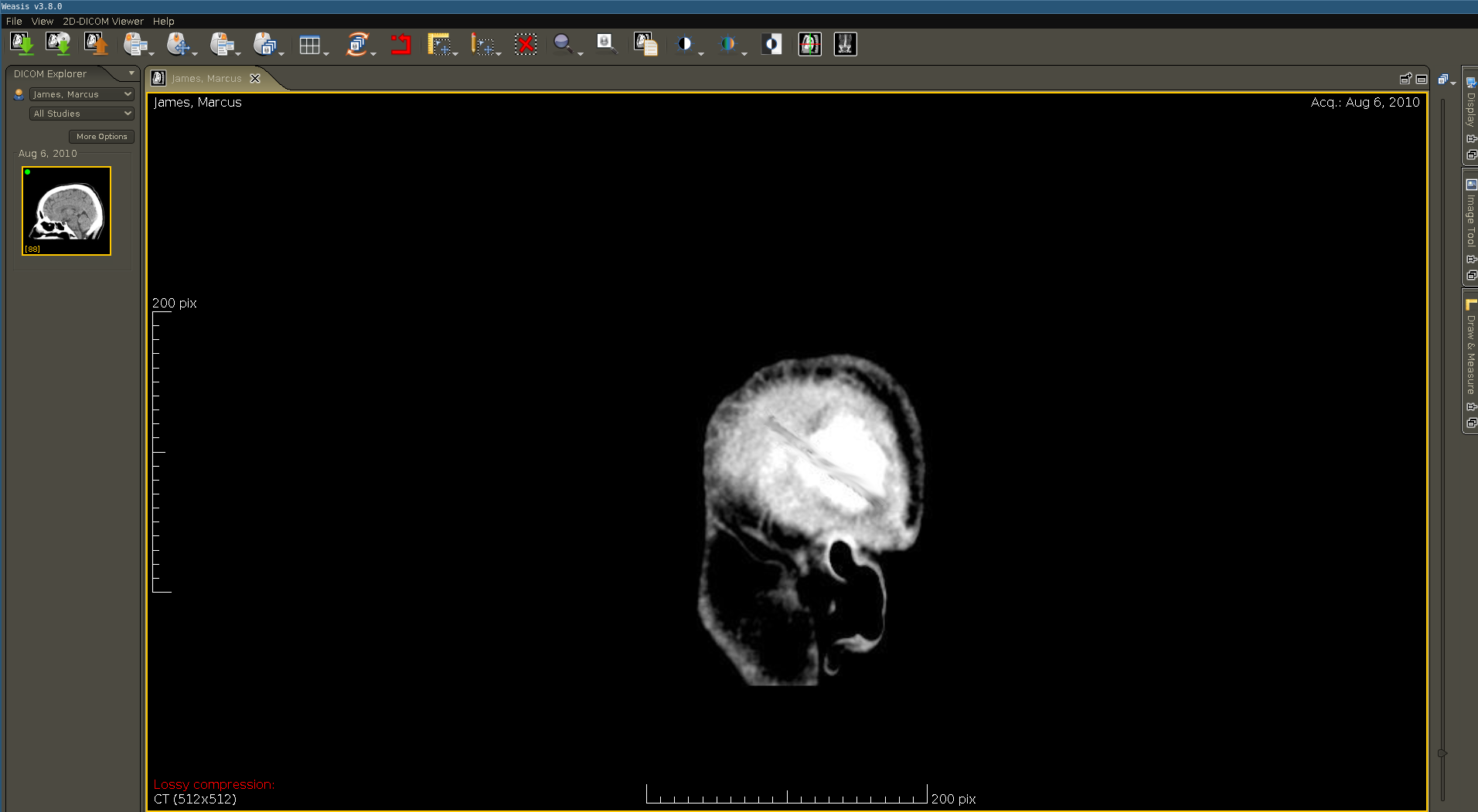 DICOM viewer displaying a sagittal CT scan of the head, showing a cross-sectional view with brain structures visible